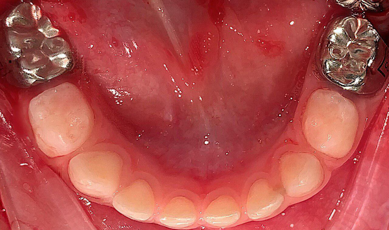 Лечение зубов под наркозом на шишкина