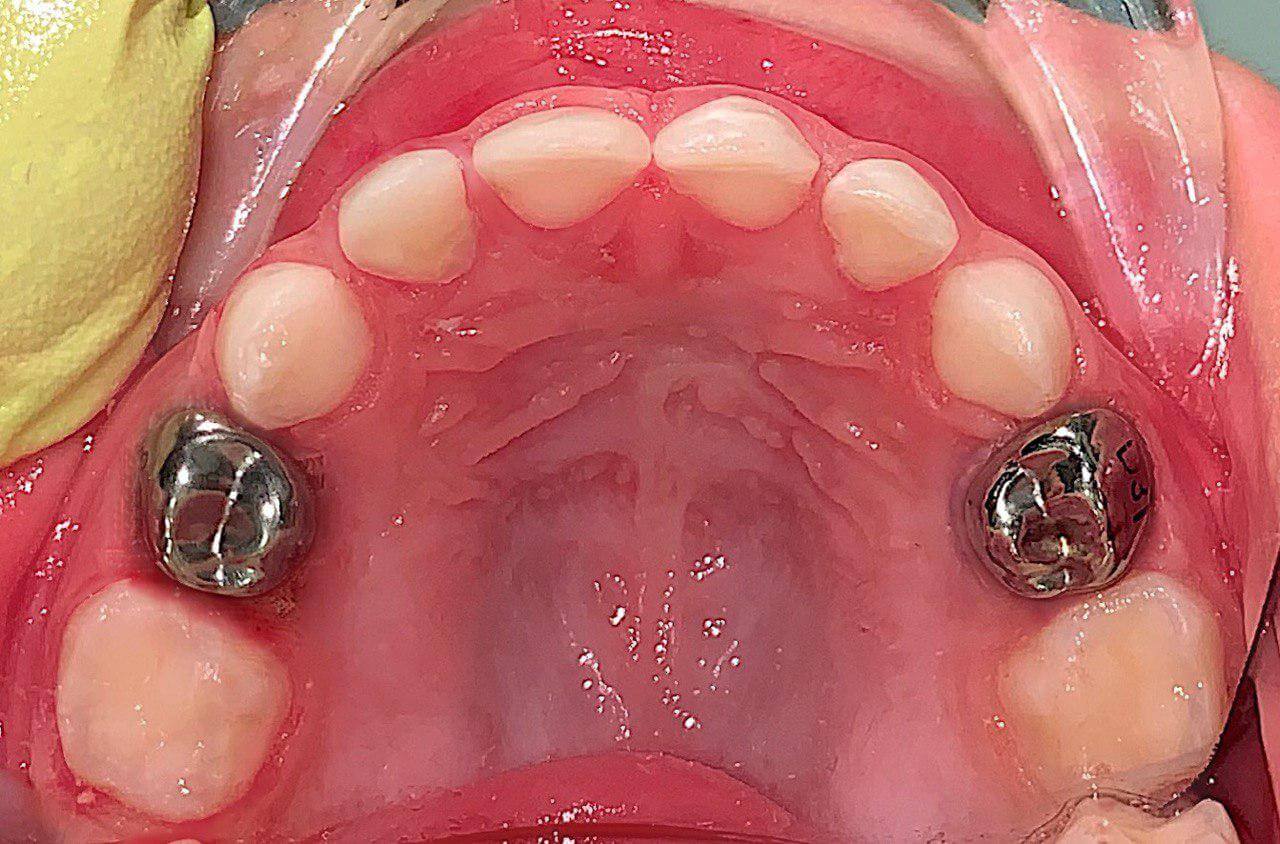 Реставрация молочных зубов Томск Вилюйский 1-й дежурная стоматология томск сегодня по полису омс