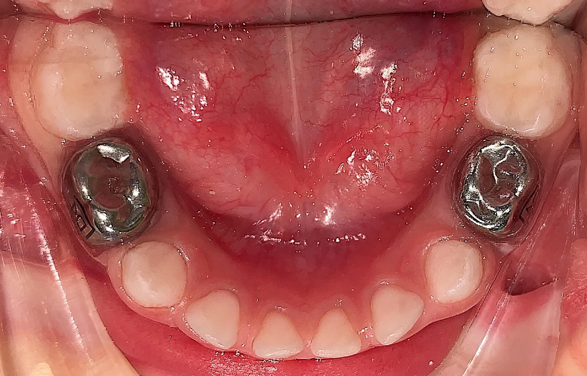 Лечение зубов под наркозом на шишкина